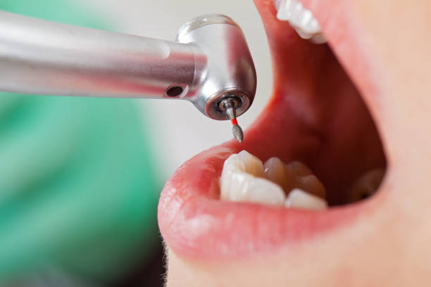 Best Emergency Dentist for Lost Fillings or Crowns in Country Clu, CA